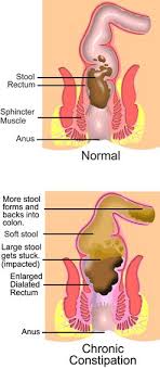 Pin On Constipation Helpful Tips