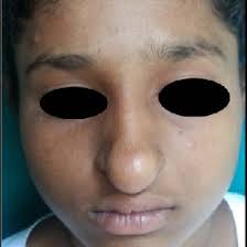 MRI showing hypodense mass lesion involving nasal tip.