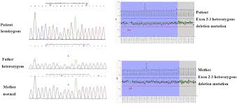Image result for acholic stools human