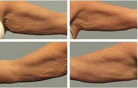 Yogurt is one of the best natural remedies if you are looking for how to get rid of crepey skin. My Crepey Skin Remedies Natural Treatments To Help Get Rid Of Crepey Skin Health Facts Journal Crepey Skin Remedies Crepey Skin Skin Health