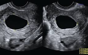 We did not find results for: An Imaging Approach To Early Pregnancy Failure