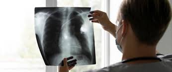 Image result for Pneumonia