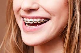 Maybe you would like to learn more about one of these? Obamacare Raised The Cost Of Your Kids Braces Marketwatch