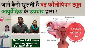 An online trilingual urdu dictionary with word meaning, definition, pronunciation, usage, synonym, antonym, idiom, proverb of urdu words. Natural Treatment For Blocked Fallopian Tubes Blocked Fallopian Tubes Treatment By Ayurveda