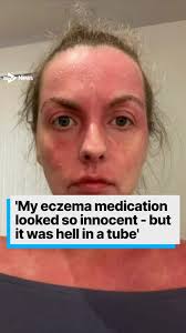 Skin patients call for more research after suffering extreme reactions ,  #skincare #scotland #news #eczema