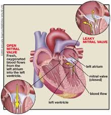 Mitral Valve Prolapse Mitral Valve Mitral Valve Prolapse Mitral Valve Regurgitation