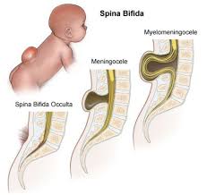 Pin On Spinal Dysraphisms