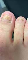 Image result for Onycholysis feet