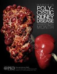 Pin By Jessica Copenhaver On Polycystic Kidney Disease Kidney Disease Awareness Polycystic Kidneys Polycystic Kidney Disease Awareness