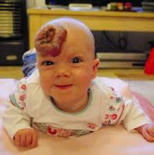Girl overcomes strawberry birthmark with new treatment