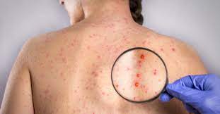 Cojite si bubite rosii am avut in anumite perioade, momentan nu am. Ce Faci Cand IÈi Apar BubiÈe Pe Corp Dr Leventer Centre