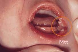 Maternidad Todo Terreno Que Es El Algodoncillo En Bebes El Algodoncillo En Bebes O Lactantes Es Una Infeccion Comun Del Area Oral Causada Por Un Hongo Llamado Candida Albicans Se Lo