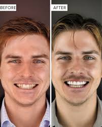 This patient came in with two old veneers