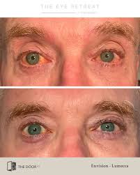 Envision by InMode for Dry Eyes — The Door W4