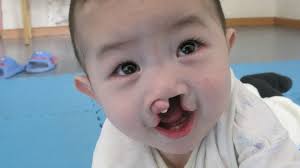 A cleft may be a small patch on the lip or a complete furrow that extends all the way to the lower part of the nose. Zhennan S Bright Eyes And Big Smiles Onesky