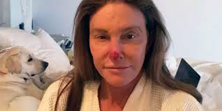 Tumors with nerve involvement, lymph node involvement or. Caitlyn Jenner Posts A Pic Of Her Skin Cancer To Instagram Caitlyn Jenner Sun Damaged Nose