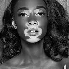 model mit weissfleckenkrankheit sie ist der star auf ny fashion week chantelle brown young chantelle brown winnie harlow