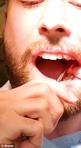 How do you pull out a tooth that is not loose? Dentistry Student Jesper Ryltoft Pulls Out His Own Wisdom Tooth On Quiet Day At Work Daily Mail Online