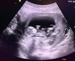 Ultraschallbilder Mehr Als 50 Bilder Aus Der Schwangerschaft Faminino