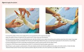 Image result for Short Arm Cast
