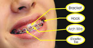 The strength of the bonding material that sticks the bracket to the tooth is a compromise between falls off too easily and really hard to get off (meaning extra pressure on the tooth that you won't like at that moment). Elastic Ligature Came Off What To Do About A Loose Orthodontic Band