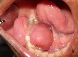 Image result for granuloma gum disease