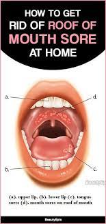 5 Simple Ways To Get Rid Of Roof Of Mouth Sore At Home Mouth Sores Roof Of Mouth Sore Sore In Mouth Remedies