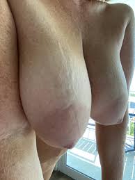 Deep stretch marks in my big hanging tits.