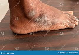Image result for brown patches on the feet