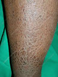 Image result for Ichthyosis