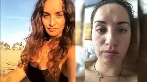 Myślała, że to atak wyrostka. Guz w jej brzuchu miał 20 cm