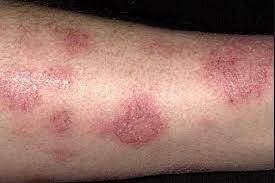 Itchy Lower Legs At Night No Rash Diabetes Skin Bumps Red Spots Dry Thyroid Causes Con Imagenes Eczema Curar Piernas