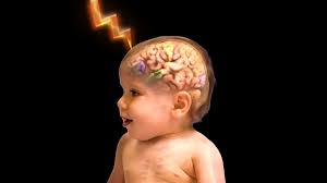 Image result for Infantile Spasms