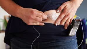 Mange våkner om morgenen med høyt blodsukker. Vil Lage Kunstig Kjertel Til Diabetikere