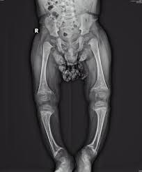 Image result for Rickets