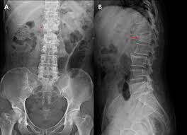 Image result for Vertebral Compression Fracture
