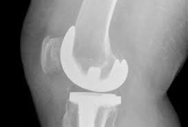 Choosing a knee surgeon takes into consideration many key points. After Your Knee Replacement Your Doctor Will Require You To Be Able To Bend Your Knee Total Knee Replacement Knee Replacement Surgery Recovery Knee Replacement