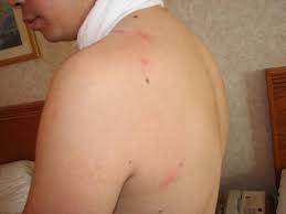 I am here to help you. Bed Bug Bites Picture Of Best Western Plus Burnaby Hotel Tripadvisor