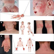 Image result for Atopic Dermatitis