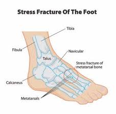 What are the symptoms of a stress fracture? Stress Fractures Of The Feet The Foot And Ankle Clinic