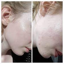 Do they tend to get worse in hot and humid weather? B A After A Year Or Two Of Everyone S Favorite Fungal Acne Skincareaddiction