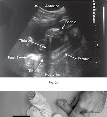 Imaging technique and findings ultrasound. Pdf Prenatal Ultrasound Diagnosis Of Club Foot Outcome And Recommendations For Counselling And Follow Up Semantic Scholar