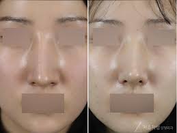 ビフォーアフター／特徴】長鼻（長い鼻）整形の特徴と症例 | チョウムチョロム美容外科