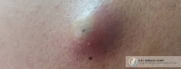 Image result for Cyst