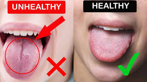 Healthy Tongue What Your Tongue Can Tell You About Your Health Tongue Appearance Diagnosis Tongue Health Chart He Healthy Tongue Tongue Health Health Chart