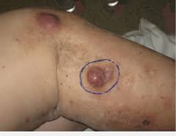 According to the american cancer society, just over 100,000 new cases of skin cancer are diagnosed in the united states each year. T3n0m0 Right Knee Melanoma Download Scientific Diagram