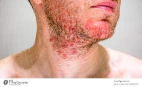 Man With Seborrheic Dermatitis In The Beard Area - A Royalty Free Stock  Photo From Photocase