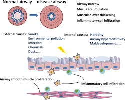 Smooth muscle has a fusiform shape, which resembles a football or spindle. Roles Of Airway Smooth Muscle Dysfunction In Chronic Obstructive Pulmonary Disease Journal Of Translational Medicine Full Text