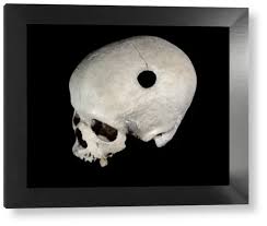 Image result for Skull Trephination