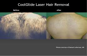 You can choose to thin the hair. How Does Laser Hair Removal Work Wembley Clinic